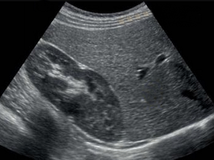 Imagen Ecografía